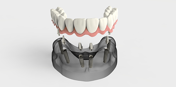 Doctrina Error Cambio Dentaduras completas sujetas con implantes - ASSSA
