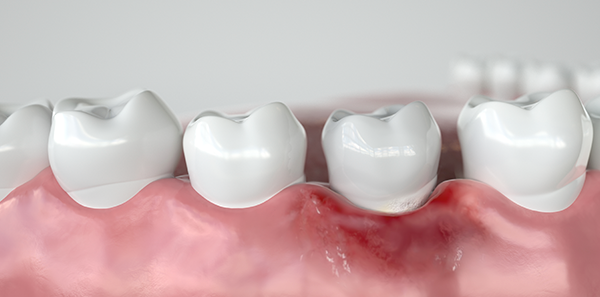 Zähne kleben lockere Behandlung wegen