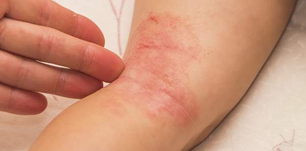 PDF) Chronic Primary Mucocutaneous Candidiasis in a Child